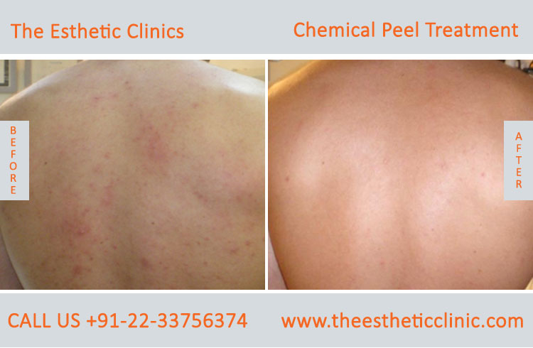 Chemical Peels Treatment before after photos in mumbai india (6)